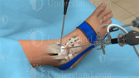 Ankle Arthroscopy Image – Understand.com