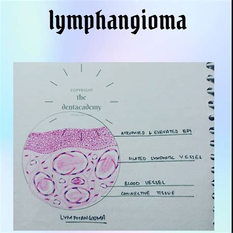 Lymphangioma | Blood vessels, Save, Pathology