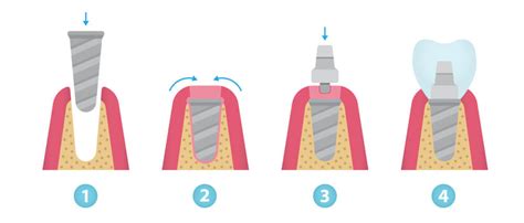 Implantes Para Personas Mayores Una Soluci N Prometedora Para La Salud