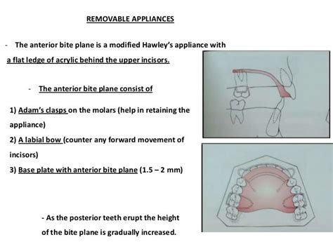 Management of Deep Bite _ Dr. Nabil Al-Zubair