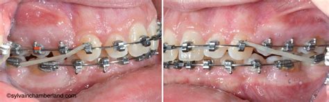 Maintain Correction With Class Ii Elastics Download Scientific Diagram