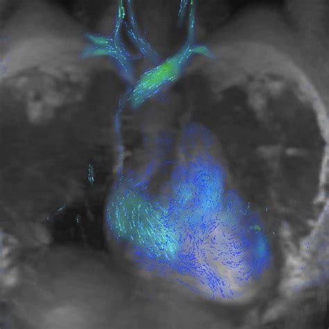 SABOURETCardiologist On Twitter RT SABOURETCardio 4Dflow WhyCMR