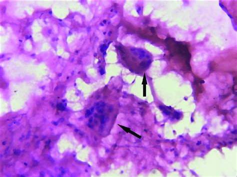 Papanicolaou Stained Smear Showing Keratin Debris With Multinucleated