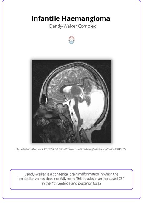 Infantile Haemagioma: Aetiology, Clinical Presentation, & Management