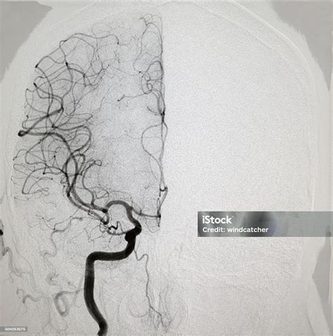 Internal Carotid Artery Angiogram