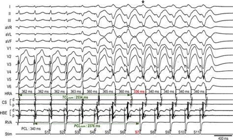 Analyses Of The Mode Of Termination During Diagnostic Ventricular Pacing To Differentiate The