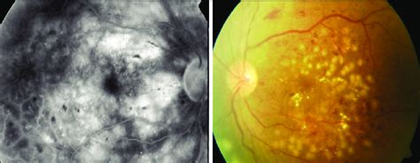 A Diffuse Macular Edema In Fundal Fluorescein Angiography B Grid