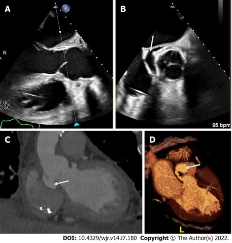 Aortic Repair With Left Ventricular Outflow Tract Pseudoaneurysm A And