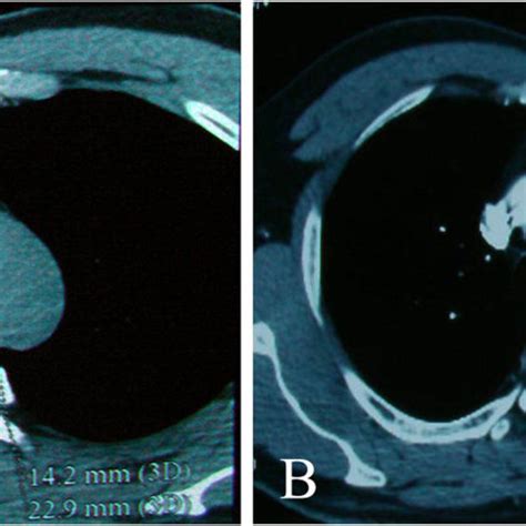 Computed tomography showed a tissue mass in the anterior mediastinum ...