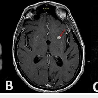 A Axial Dwi Sequence Mri Brain Demonstrating Small Acute Ischemic