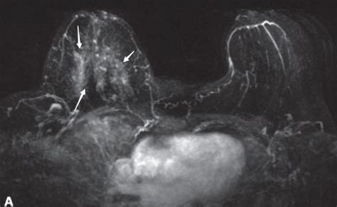 Pre Operative Breast Mri In A Year Old Woman With Biopsy Proven