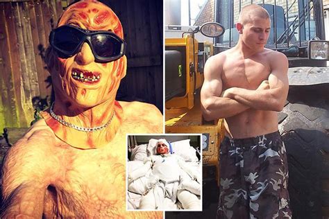 Hgv Driver Who Suffered 80 Burns In Freak Accident Is Dubbed Crispy By Pals And Goes Clubbing