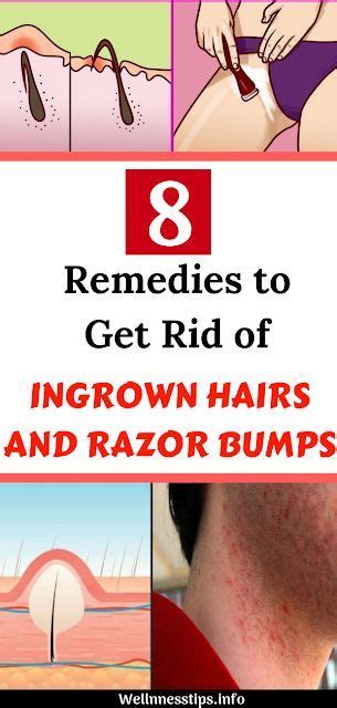 8 Home Remedies To Get Rid Of Ingrown Hairs And Razor Bumps Ingrown