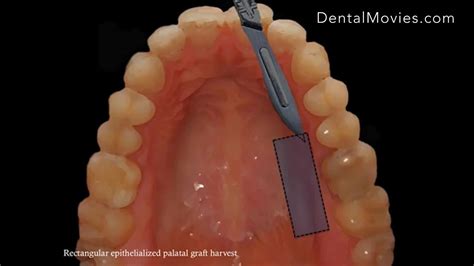 How Does A Free Gingival Graft Work Surgicalmaster Youtube