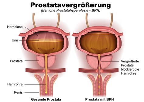 Benigne Prostatahyperplasie Ursachen Symptome Behandlung