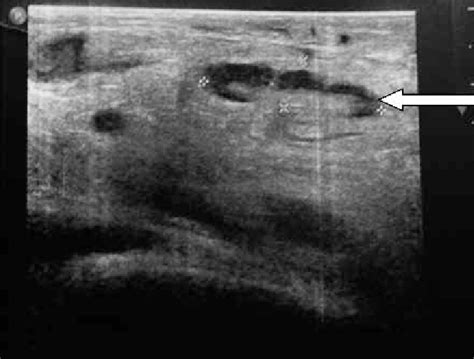 Inguinal Lymph Node Ultrasound