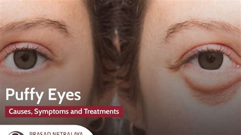 Puffy Eyes Causes Symptoms And Treatments Puffy Eyes Treatment Puffy