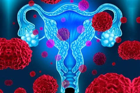 Cáncer De Cuello Uterino Conoce Los Síntomas De Alarma