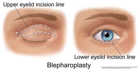 Eyelid Surgery Panama City Blepharoplasty Panama City The Eye Center Of North Florida