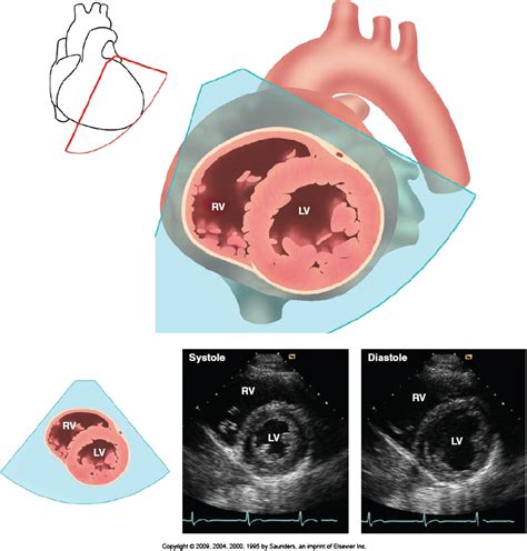 The Role Of Echocardiography In Hemodynamic Assessment Of Septic Shock