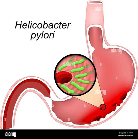Cross Section Of A Human Stomach With Ulcers Close Up Of Bacteria