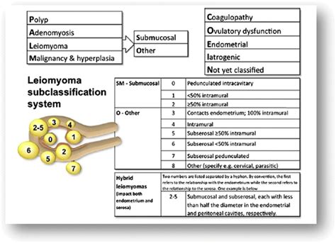 FIGO Classification Of Fibroids Used With Permission From Munro M G