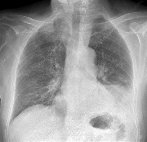 Lobar pneumonia, lung X-ray - Stock Image - C037/2879 - Science Photo ...