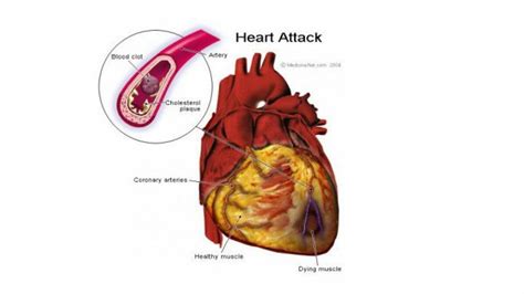 Diseased Human Heart From Smoking