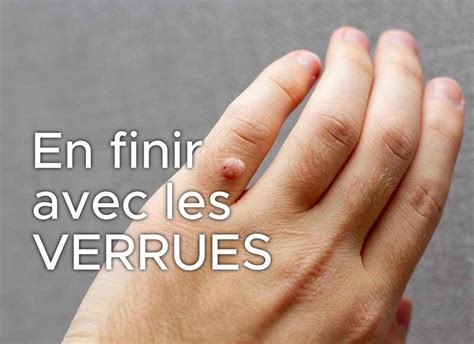 Verrues Astuces Naturelles Pour En Venir Bout Verrue