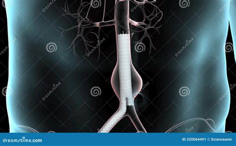 Abdominal Aortic Aneurysm Repair Stock Illustration - Illustration of ...