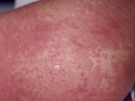 La Dermatología Tiene Problemas Con El Color De La Piel