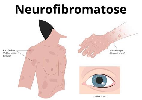 Neurofibromatose Ursachen Behandlung Prognose