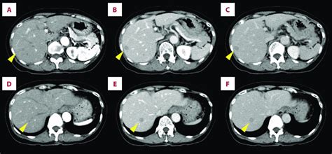 Contrast-enhanced CT revealed that the hepatic masses (arrowheads ...