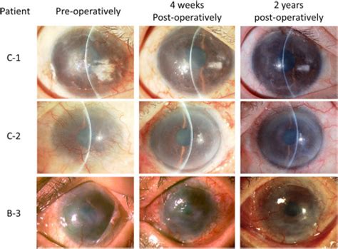 Clinical Trial Of Autologous Cultivated Limbal Epithelial Cell Sheet