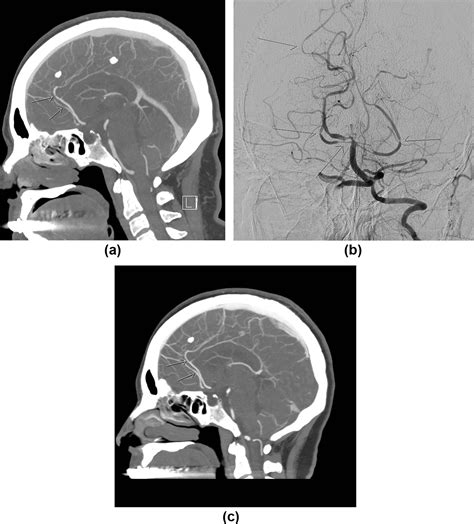 Reversible Cerebral Vasoconstriction Syndrome An Important And Common Cause Of Thunderclap And