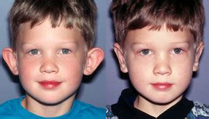 Corrective Ear Surgery for Children in Seattle-Bellevue