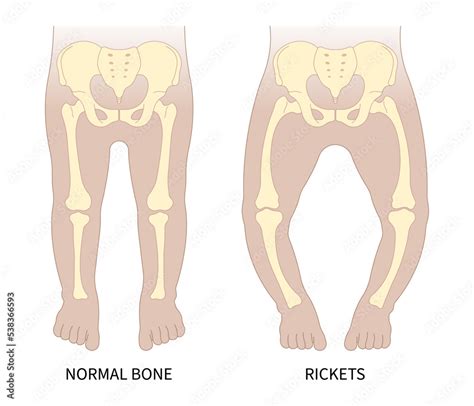 lack of vitamin D with rickets Blount's and Paget's disease x-ray hip ...