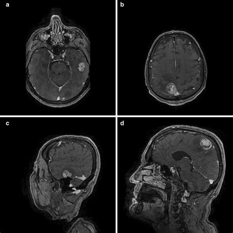 Contrast Enhanced T1 Weighted Magnetic Resonance Imaging Scans