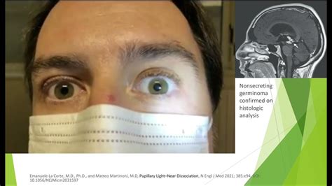 Supranuclear Vertical Gaze Palsy Ppt Parinaud S Syndrome Double Elevator Palsy Youtube