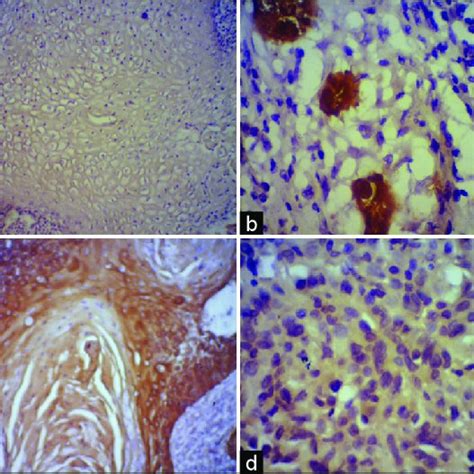 Protein Expression Analysis Of Esophageal Squamous Cell Carcinoma