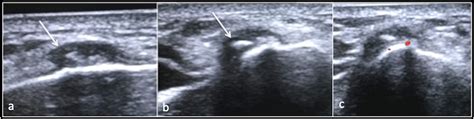 Calcific Tendinopathy Of The Pronator Quadratus Muscle A Rare Site And