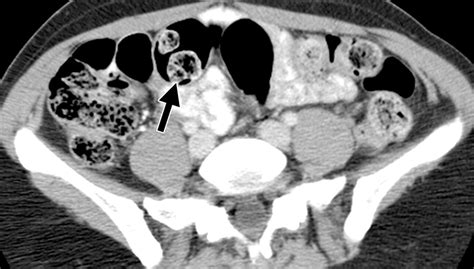 Ct Findings In Adult Celiac Disease Radiographics