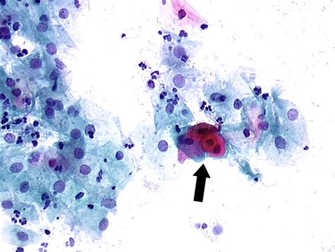 Cytopathology Of The Uterine Cervix Digital Atlas