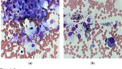 Figure 3 From Secondary Hemophagocytic Syndrome In A Patient With