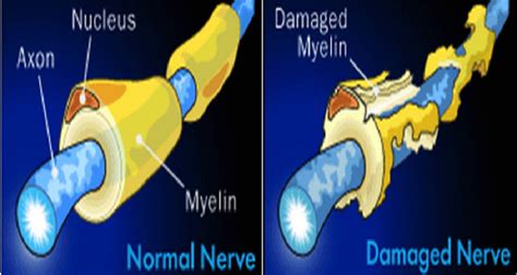 Nanoparticles Used to Deliver Myelin Repair Molecule