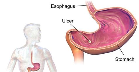 Dispepsia Causas Y Sintomas Dra Rivera Sistema Digestivo