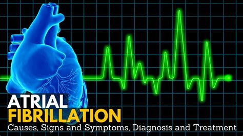 Atrial Fibrillation Causes Signs And Symptoms Diagnosis And