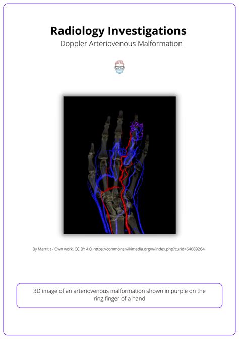 Infantile Haemagioma: Aetiology, Clinical Presentation, & Management