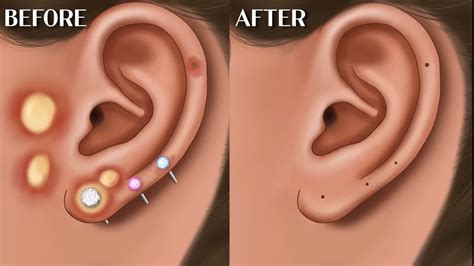 Asmr Ear Piercing Pus Removal Animation Animation Viral Asmr Youtube