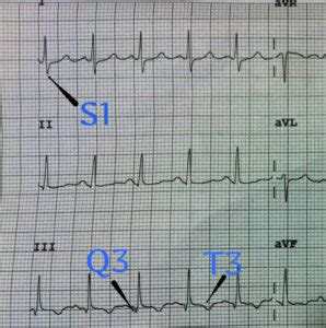 Spot en lunge-emboli på EKG’et – Ambulancevejen